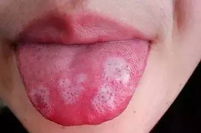 得了口腔白斑怎么治疗