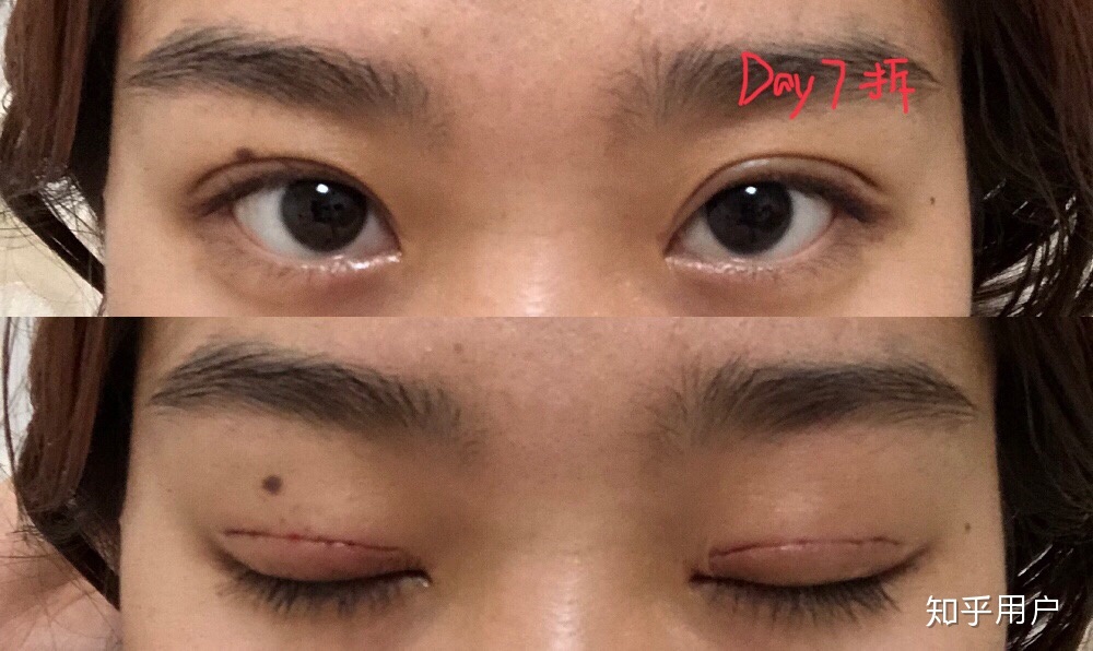 割双眼皮变窄