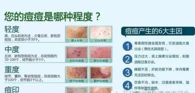怎么去除囊肿型痘痘