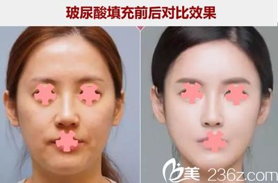 玻尿酸填充面颊