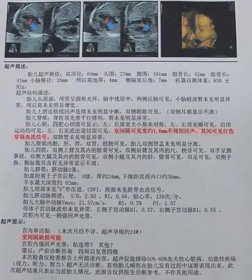 新生儿室间隔缺损