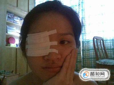 长针眼怎么治疗