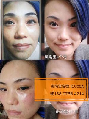 去斑美白要多少钱