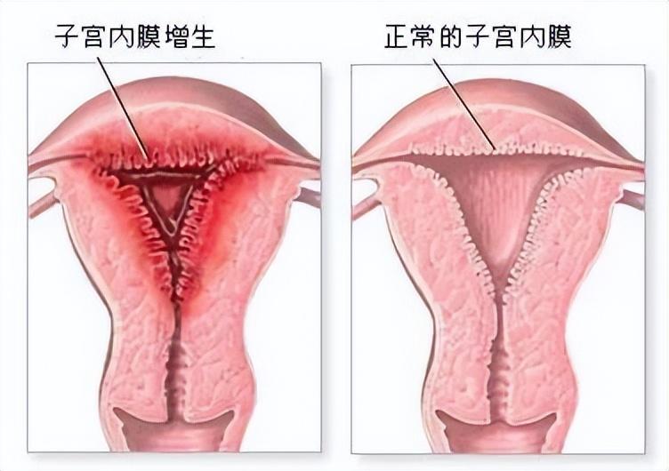 内膜增厚怎么治疗好