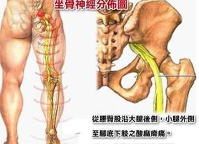 腰突怎么治疗
