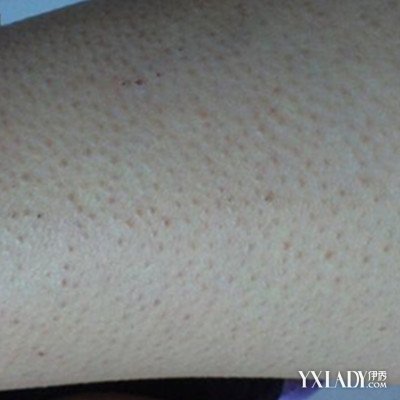 包皮浮肿是怎么回事