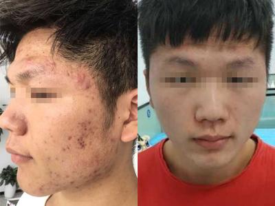额头长了囊肿痘痘