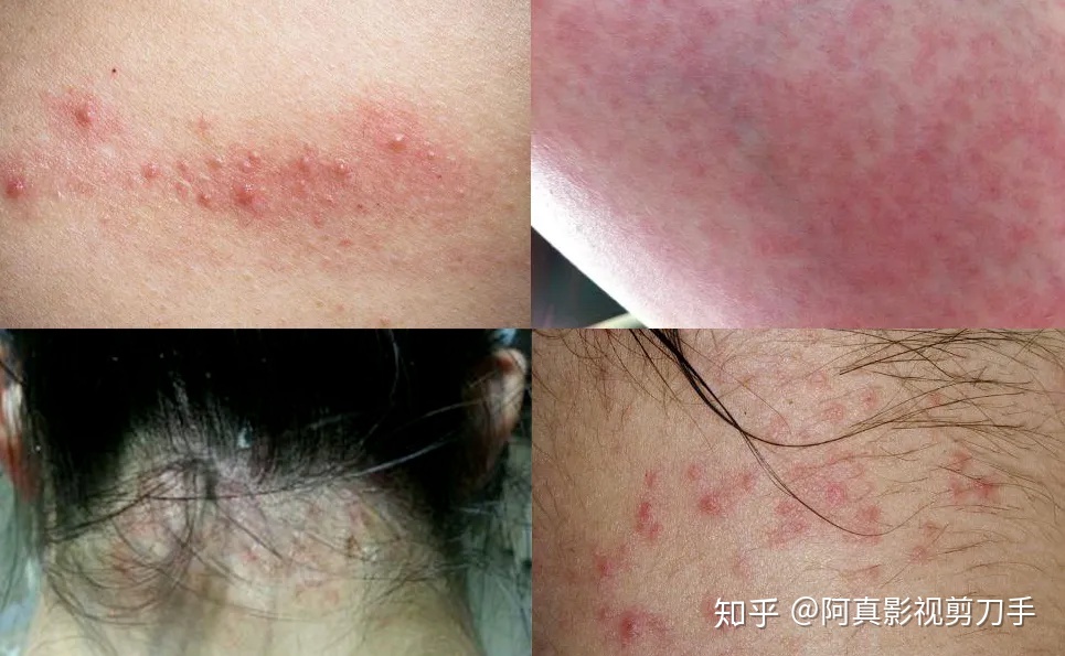 孕妇脖子上长痘痘怎么办