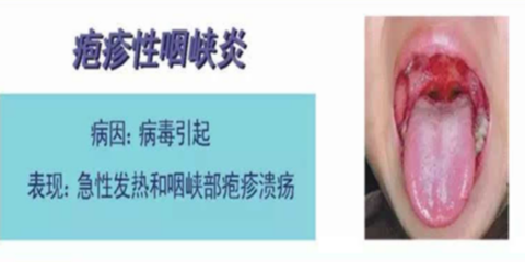 小孩子咽炎该怎么治疗
