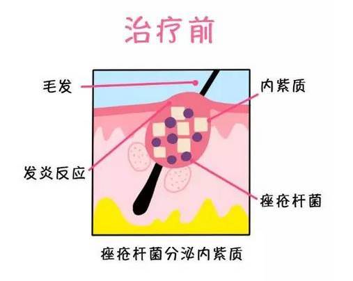 蓝光祛痘原理
