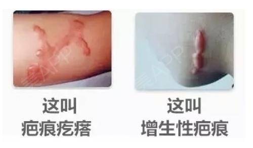 怎么确定是不是疤痕体质
