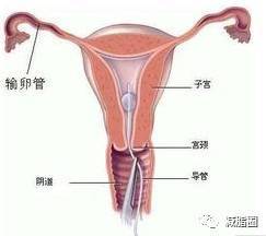 输卵管扩张是怎么回事