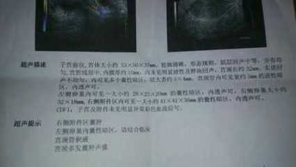 宫颈管积液影响怀孕吗