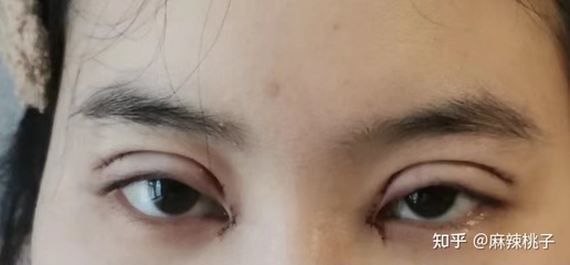 沈阳 双眼皮