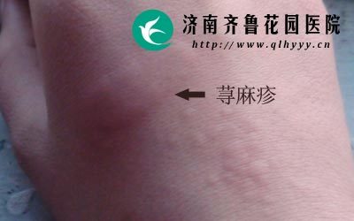 孕妇荨麻疹如何治疗