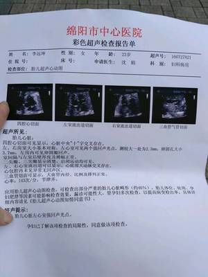 胎儿在左边