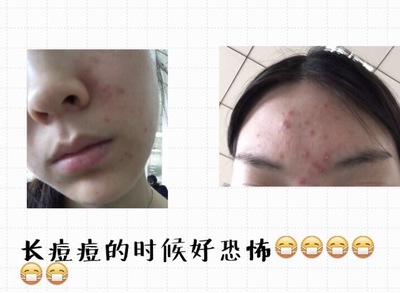 长痘痘变好的帖子