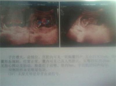 听诊器对胎儿有影响吗