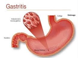 suspected gastritis