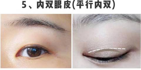 单眼皮肿眼泡怎么贴双眼皮