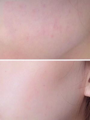 敏感肌痘痘肌