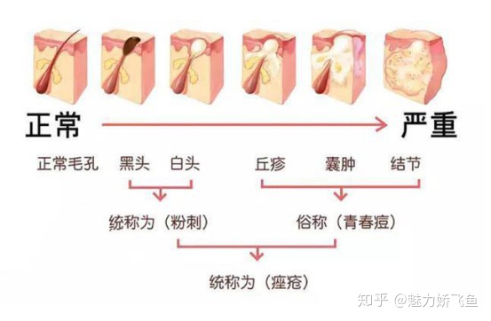 丘疹型痘痘严重么