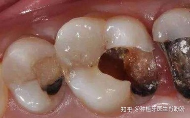 根管治疗怎么治