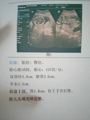 四个月胎动