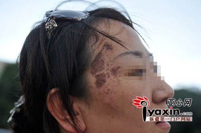 两鬓总是长痘痘是什么原因