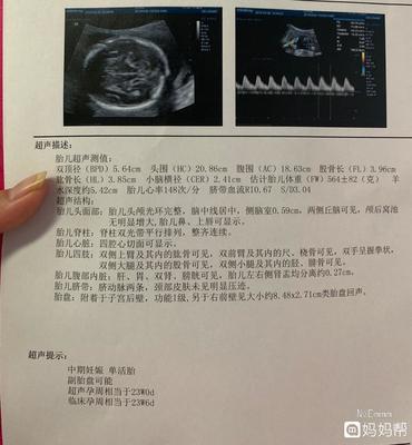 胎儿心率148