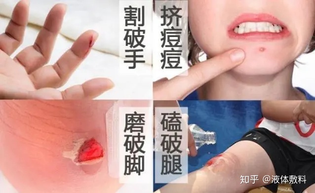 挤痘痘之后的伤口愈合