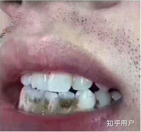 吸烟牙黄洗牙能变白吗