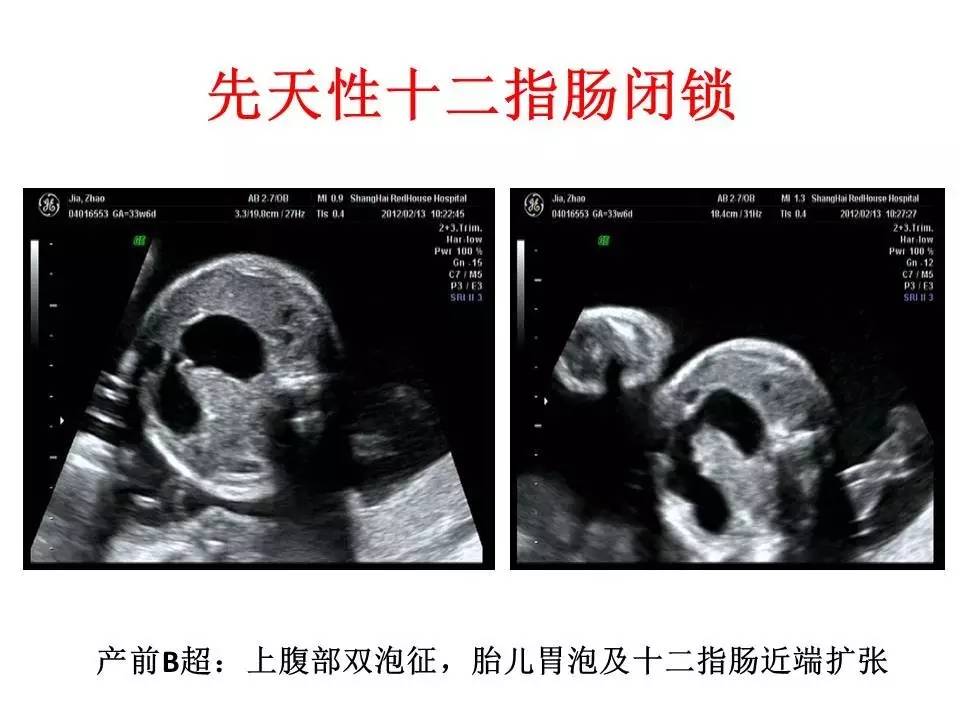 胎儿消化道畸形