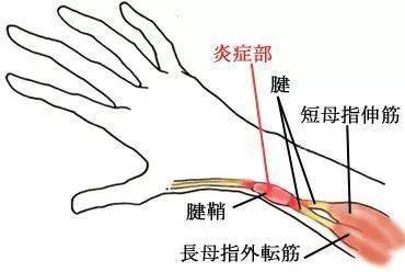 什么是腱鞘炎怎么治疗