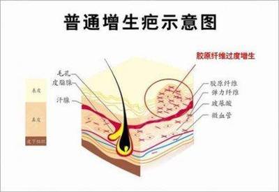 上海明桥 痘痘
