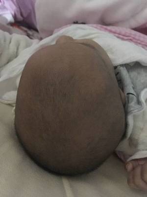 新生儿头后面凹陷图片