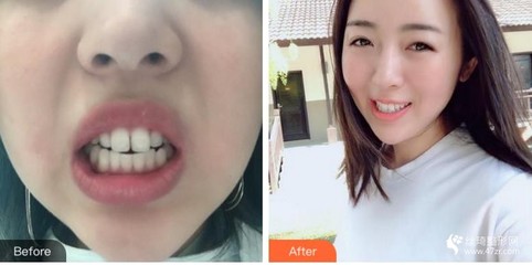 华西口腔牙齿美容冠多少钱