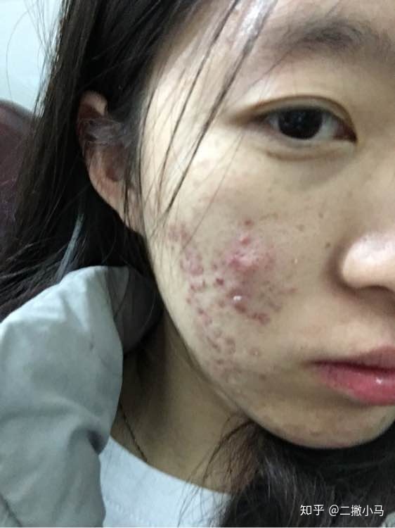 脓包型痤疮怎么治疗