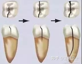 牙齿咬东西酸软无力怎么治疗