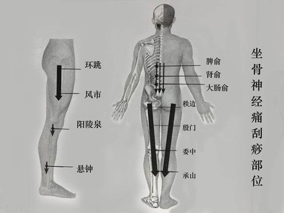 坐骨疼是怎么回事