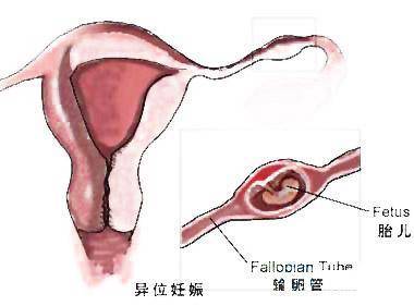 上环有可能怀孕吗