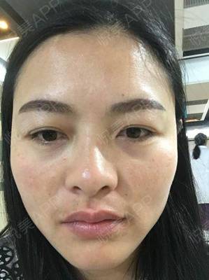 玻尿酸打泪沟几天消肿