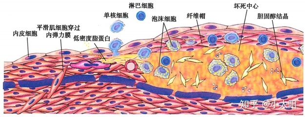胆固醇结晶是怎么回事