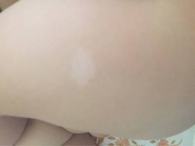 宝宝身上有白斑