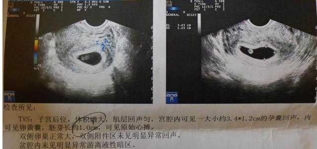 怀孕8周胎儿图片欣赏