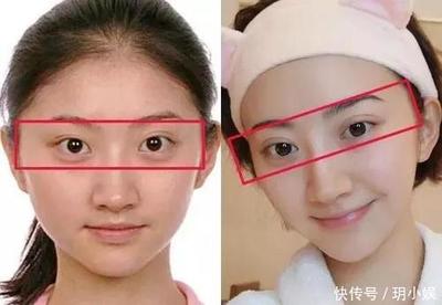 双眼皮会失败吗