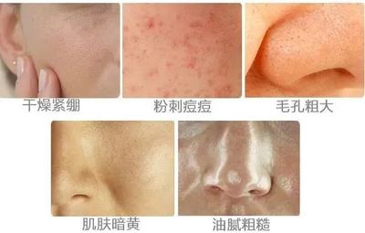 闭口痘痘粗糙