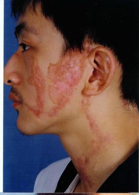 线状疣怎么治疗