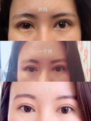 割过双眼皮多久可以化妆
