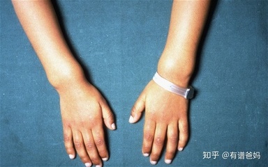 佝偻病怎么治疗效果好